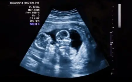 متى يظهر الحمل بتوأم في كيس واحد بالسونار