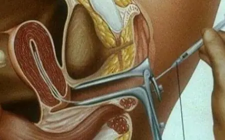 تجربتي في تحديد نوع الجنين بالتلقيح الصناعي