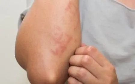 هل ماء البحر يقضي على الجرب