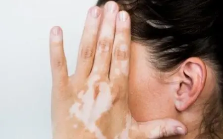 تجربتي مع توحيد لون البهاق