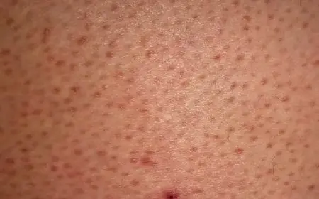 تجربتي في علاج جلد الوزة