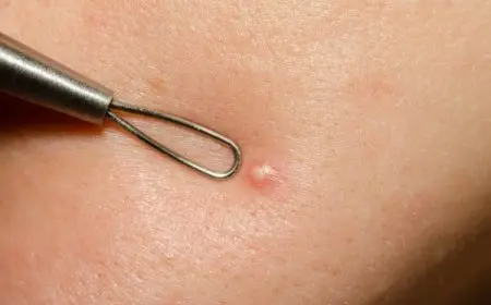 تجربتي مع الكيس الدهني