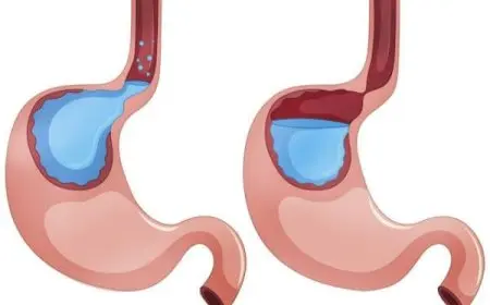 تجربتي مع التهاب المريء