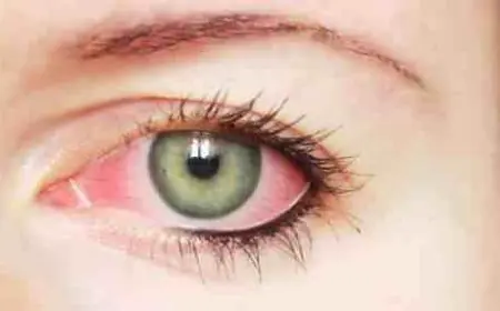 تجربتي مع التهاب القزحية