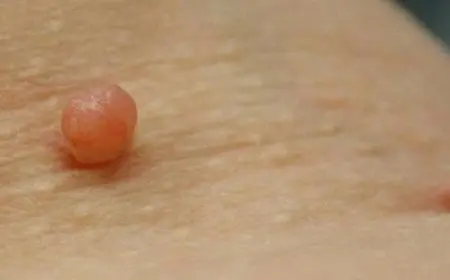 تجربتي مع الزوائد الجلدية