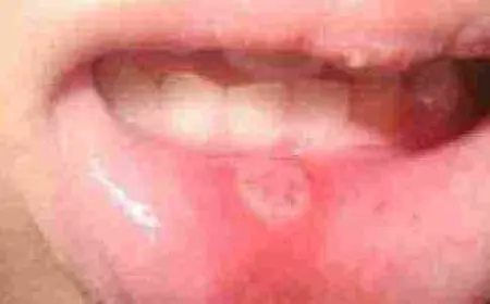 حبوب داخل الفم من جهة الخد