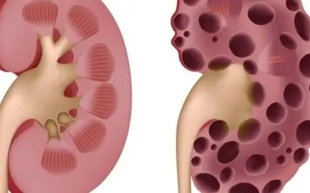 تجربتي مع ارتفاع الكرياتينين