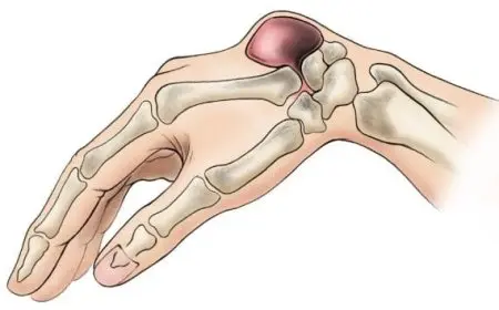 تجربتي مع الكيس الزلالي