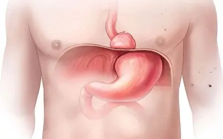 تجربتي مع عملية فتق الحجاب الحاجز