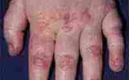 أعراض الروماتيزم في الدم