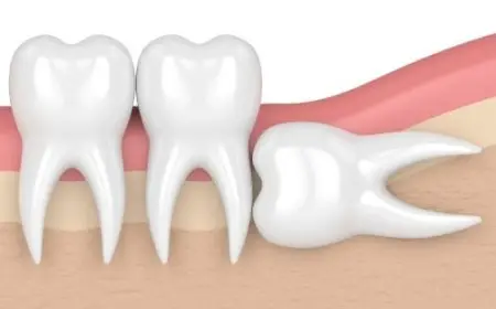 علاج الضرس المحفور في البيت