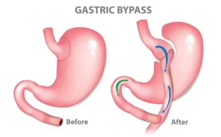 تجربتي مع تحويل مسار المعدة