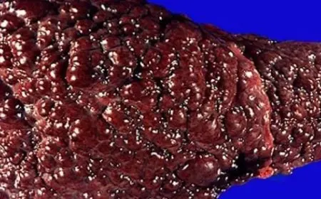 تجربتي مع تليف الكبد