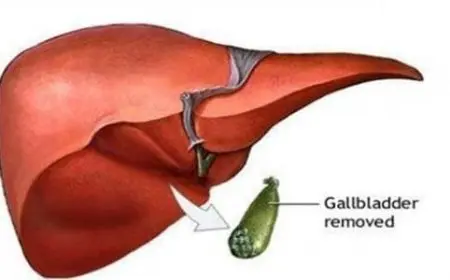 كيف يتم هضم الدهون بعد استئصال المرارة