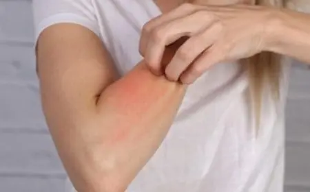 أسماء أدوية الحساسية الجلدية 