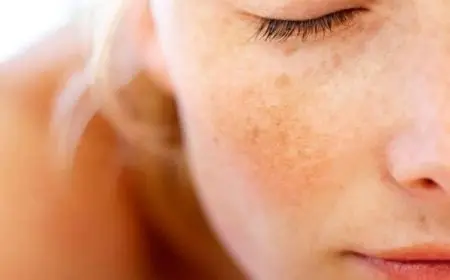 علاج الكلف في الوجه