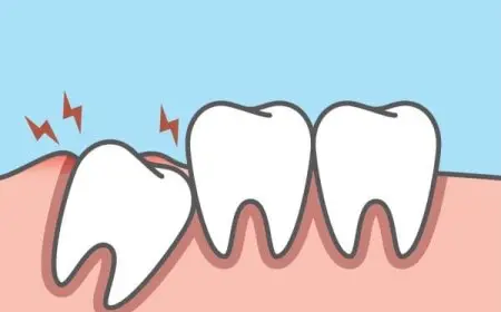 مدة ألم ظهور ضرس العقل