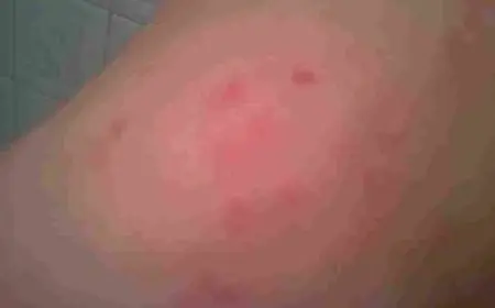 أفضل مضاد حيوي لالتهاب الغدد اللمفاوية