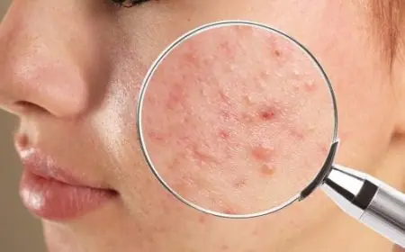 علاج الحبوب الصغيرة في الوجه بسرعة