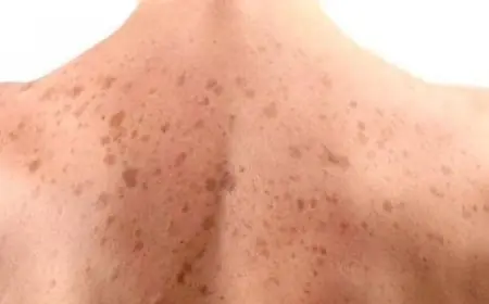 أسباب تصبغات الجلد البنية