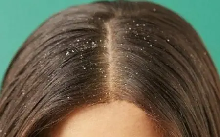 أسباب قشرة الشعر عند النساء