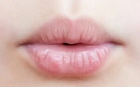 أسباب تشقق الشفاه السفلى