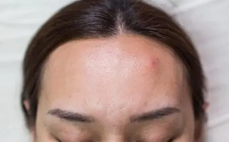 أسباب ظهور ورم في الجبهة